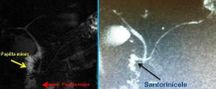 Pancreas Divisum visualizzato con Colangio RMN e dopo stimolo secretinico